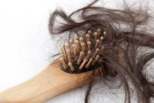 Алопеция - это неестественная потеря волос на голове или других частях тела
