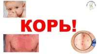 Корь является высококонтагиозной инфекционной болезнью, вызываемой вирусом